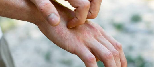 psoriasis en goutte